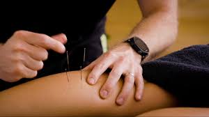Acupuncture Treatment Gilbert, AZ